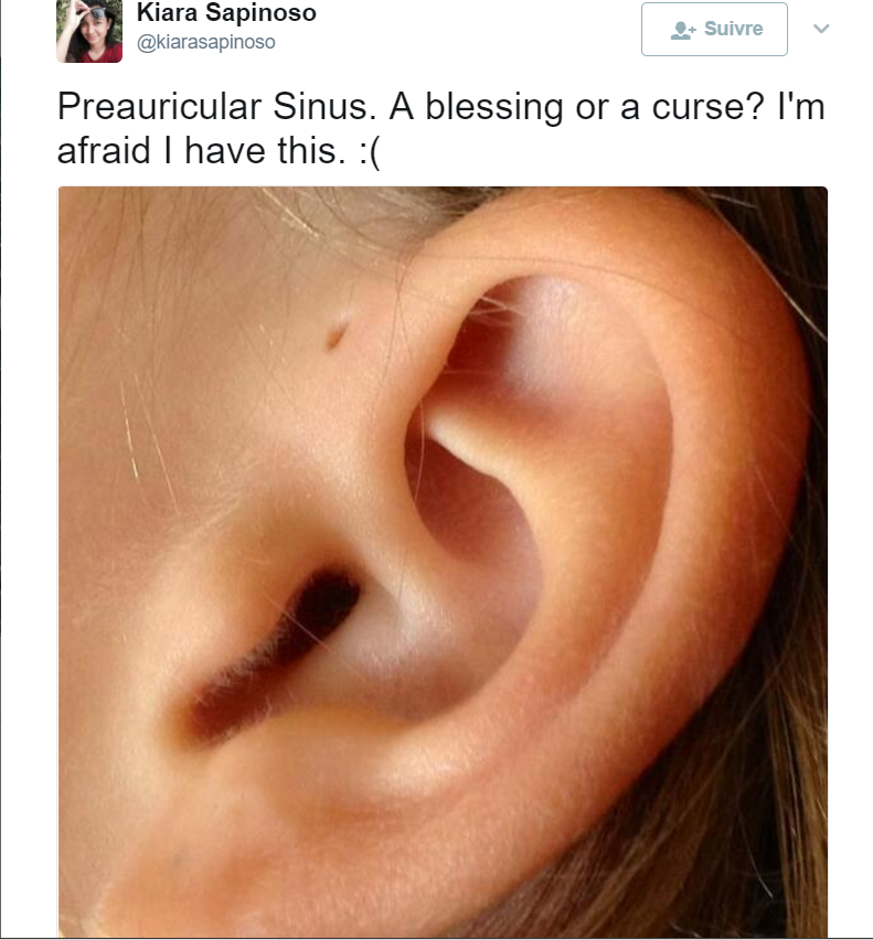 Voici pourquoi certaines personnes ont un petit trou à l'oreille!